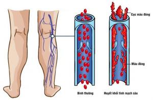 Huyết Khối Tĩnh Mạch Sâu Chi Dưới