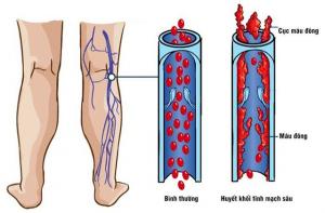 Lower Extremity Venous Thrombosis