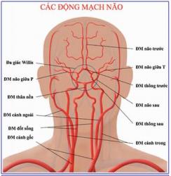 Đột quỵ não - bệnh động mạch cảnh