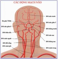 Brain stroke - carotid artery disease.