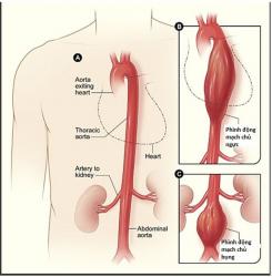 Complications of abdominal aneurysm ruptured.