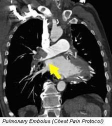Who should have a Cardiac CT?