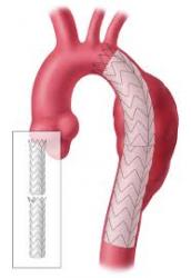 Đặt Stent Graft Động Mạch Chủ Ngực