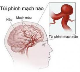 Phình Động Mạch Não