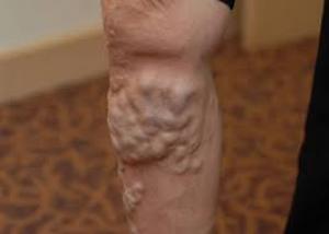 Varicose Veins Leg