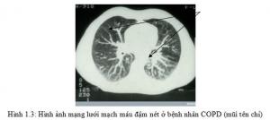 BỆNH PHỔI TẮC NGHẼN MÃN TÍNH (P.1)