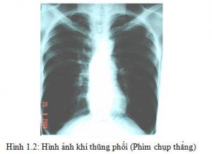 BỆNH PHỔI TẮC NGHẼN MÃN TÍNH (P.2)