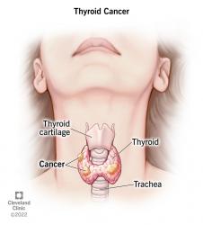 Thyroid Cancer