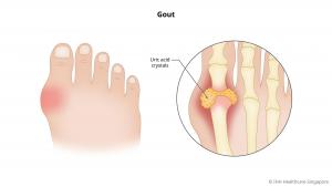 Bệnh Gout