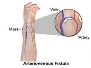 Arteriovenous bypass surgery