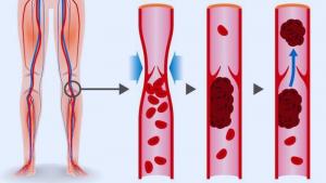 Deep Vein Thrombosis ( DVT )