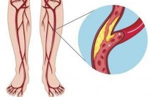 Peripheral Artery Disease Angioplasty