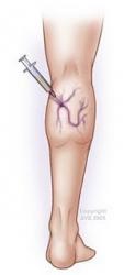 Sclerotherapy Injection